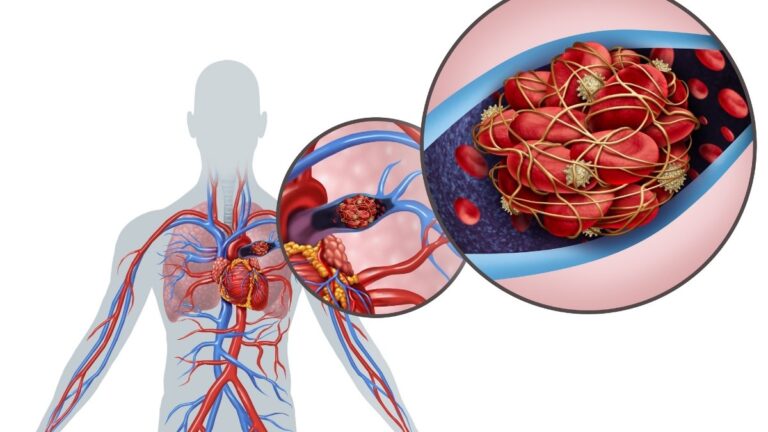 15 Foods Over 50s With Arthritis Should Avoid at All Costs (Making Your Joint Pain Worse)