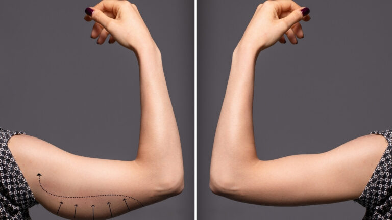 Bye-Bye Arm Jiggle! 5 Easy Moves to Tone Flabby Arms (No Weights Needed!)