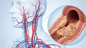 The Arterial Plaque Contributors: 4 Common Cooking Oils You Should Throw Out Immediately